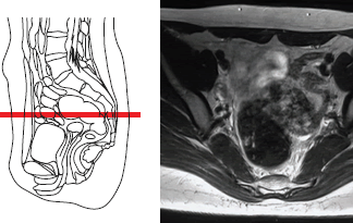 Magnetic resonance imaging (MRI) of the pelvic organs in a woman (uterus and appendages are visible).
